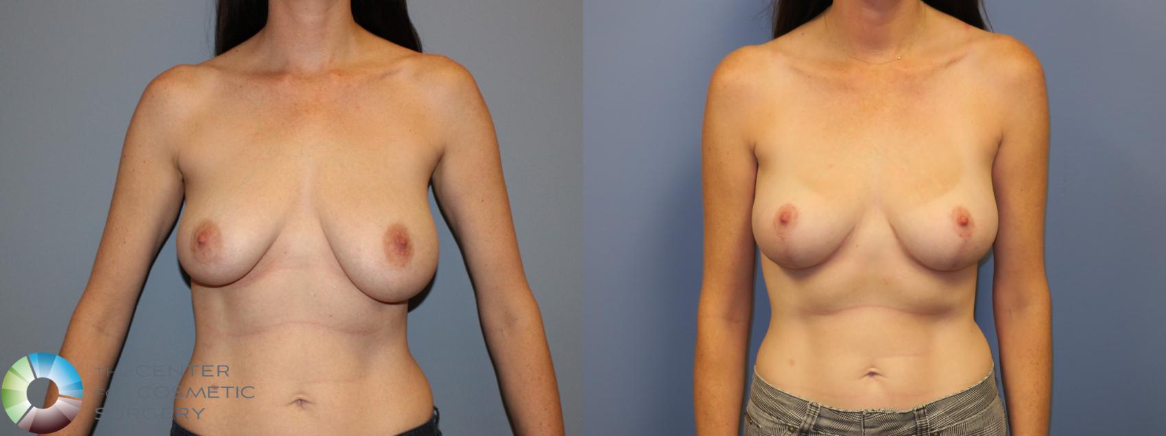 Before & After Breast Lift without Implants Case 11520 Front in Denver, CO