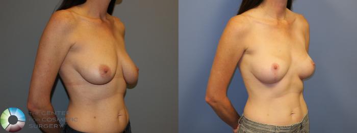 Before & After Breast Lift Case 11520 Right Oblique View in Golden, CO