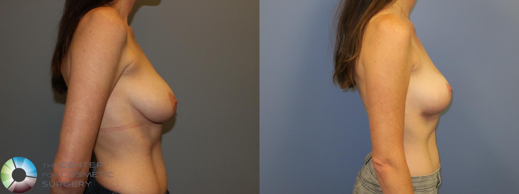 Before & After Breast Lift without Implants Case 11520 Right Side View in Golden, CO