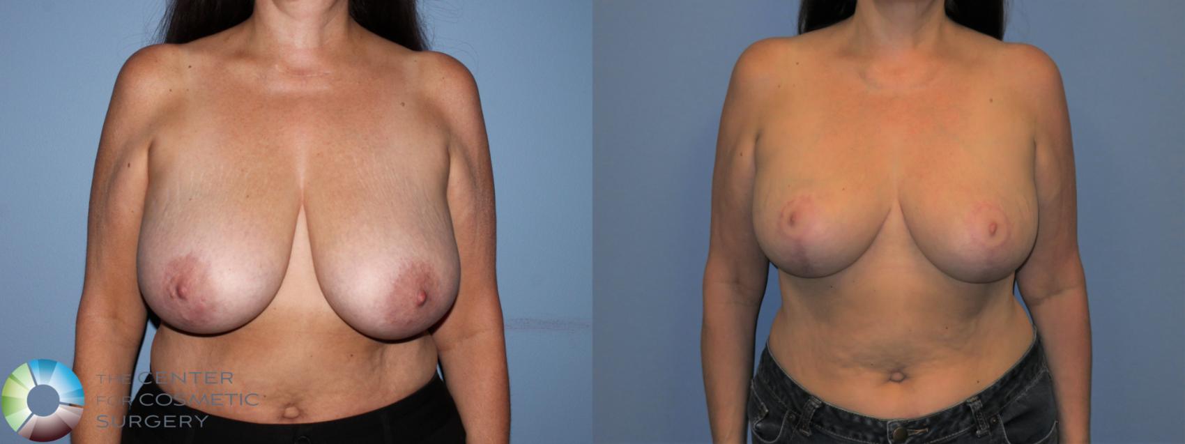 Before & After Breast Lift without Implants Case 11521 Front View in Golden, CO