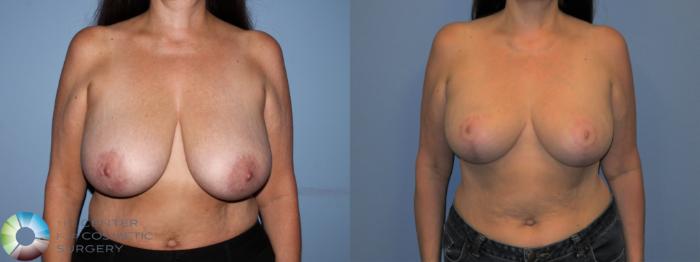 Before & After Breast Lift without Implants Case 11521 Front in Denver, CO