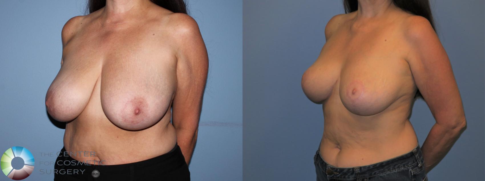 Before & After Breast Lift without Implants Case 11521 Left Oblique View in Golden, CO