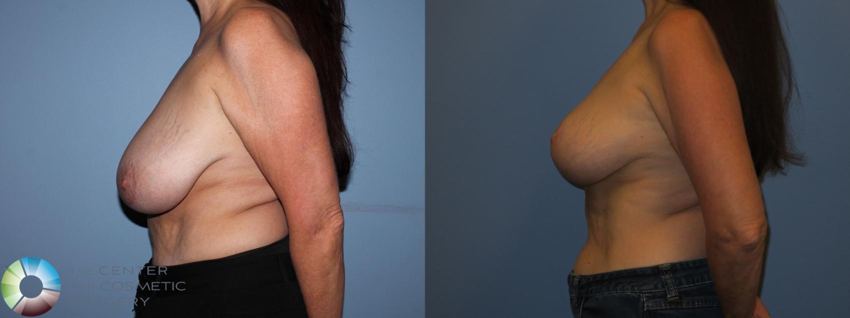 Before & After Breast Lift without Implants Case 11521 Left Side View in Golden, CO