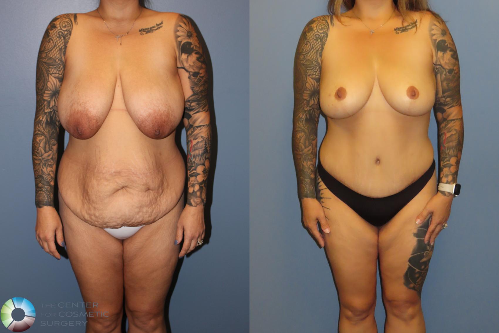 Before & After Tummy Tuck Case 12067 Front in Denver and Colorado Springs, CO