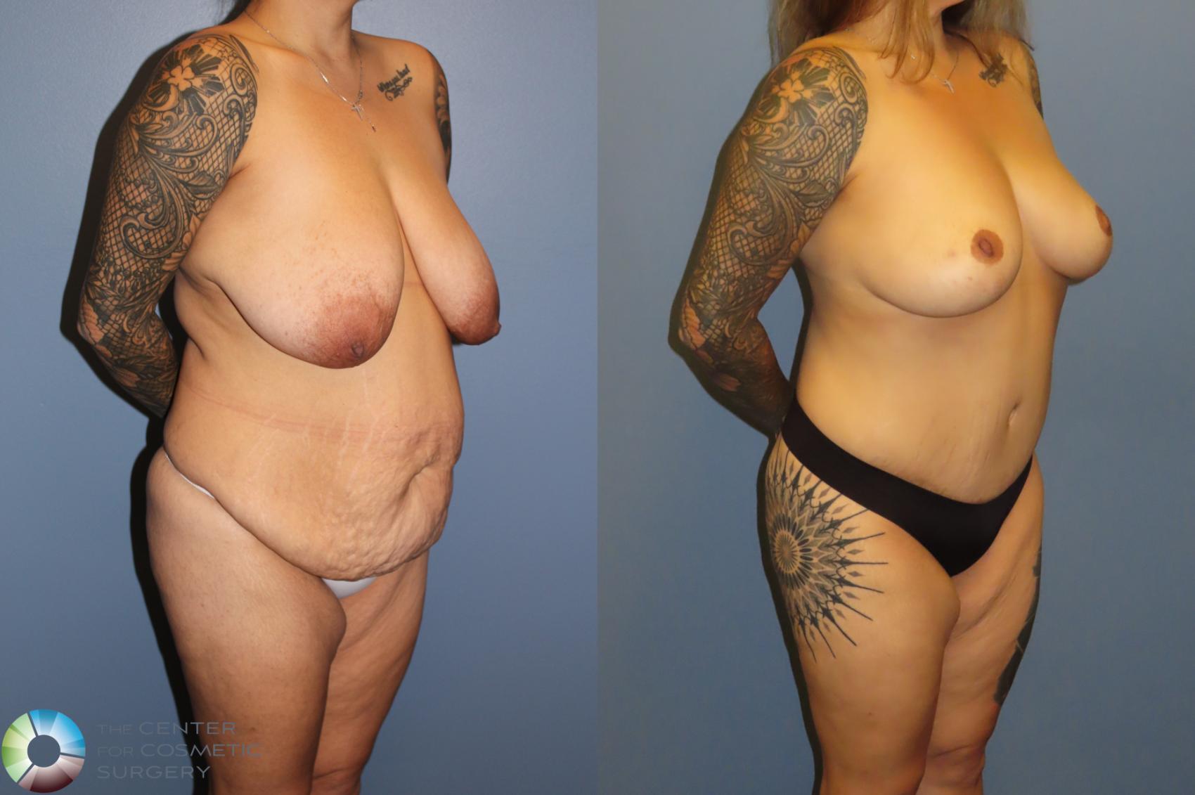 Before & After Breast Lift without Implants Case 12067 Right Oblique in Denver and Colorado Springs, CO