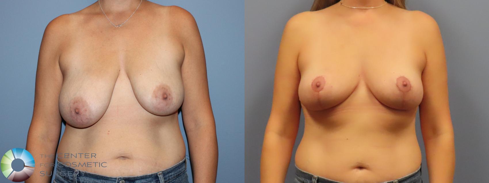 Before & After Breast Lift Case 12085 Front in Denver and Colorado Springs, CO