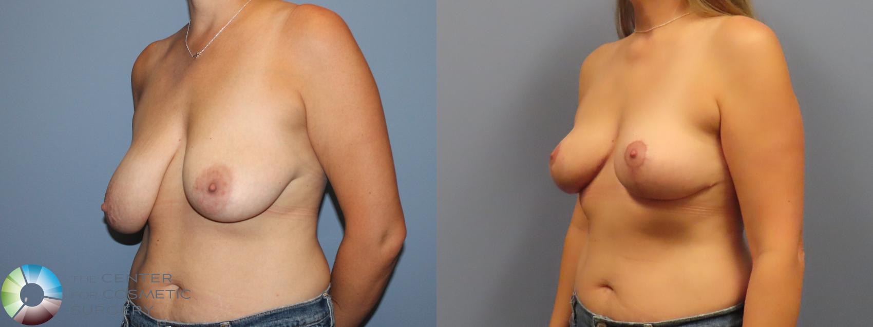 Before & After Breast Lift without Implants Case 12085 Left Oblique in Denver and Colorado Springs, CO
