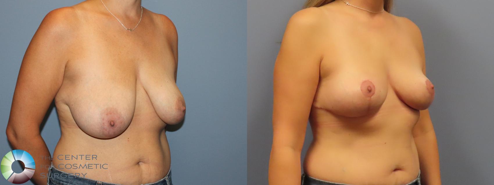 Before & After Breast Lift without Implants Case 12085 Right Oblique in Denver and Colorado Springs, CO