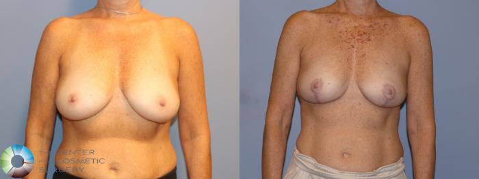 Before & After Breast Lift without Implants Case 12116 Front in Denver and Colorado Springs, CO