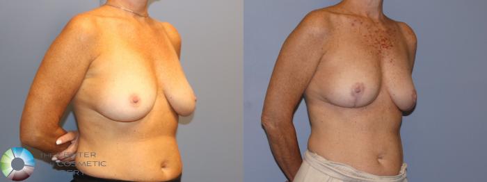 Before & After Breast Lift without Implants Case 12116 Left Oblique in Denver and Colorado Springs, CO