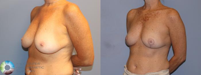 Before & After Breast Lift without Implants Case 12116 Right Oblique in Denver and Colorado Springs, CO