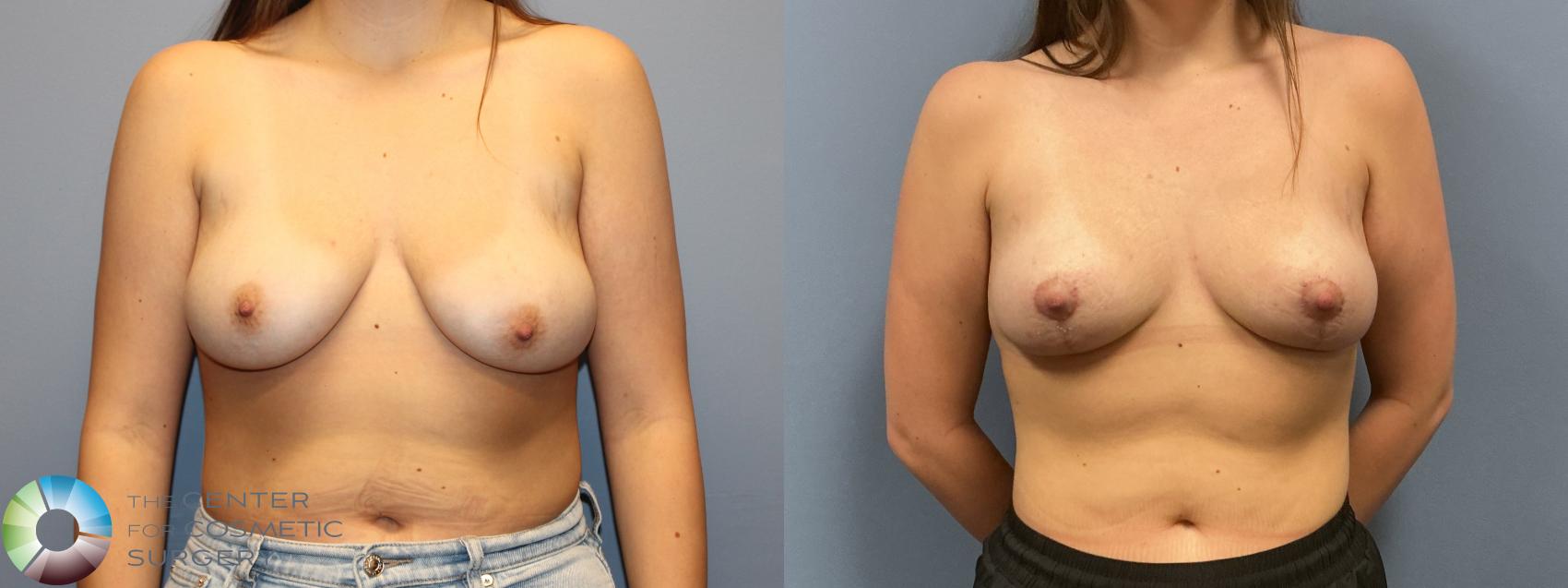 Before & After Breast Lift without Implants Case 12229 Front in Denver and Colorado Springs, CO