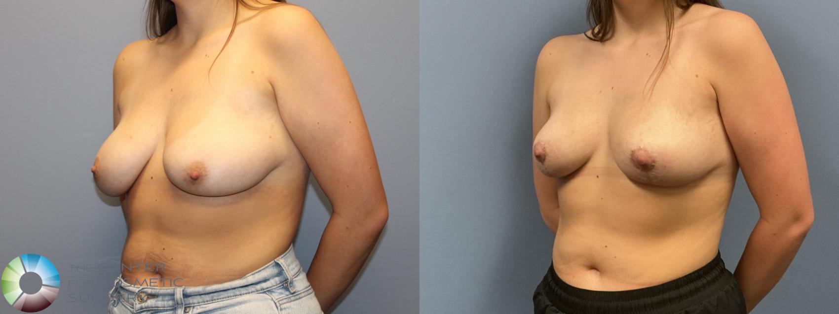 Before & After Breast Lift without Implants Case 12229 Left Oblique in Denver and Colorado Springs, CO