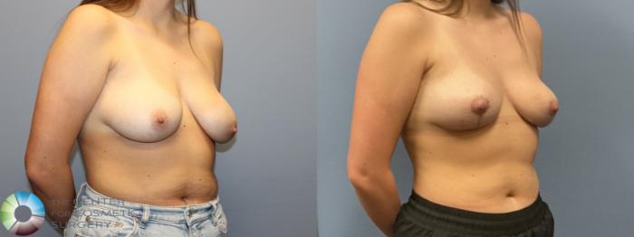 Before & After Breast Lift Case 12229 Right Oblique in Denver and Colorado Springs, CO