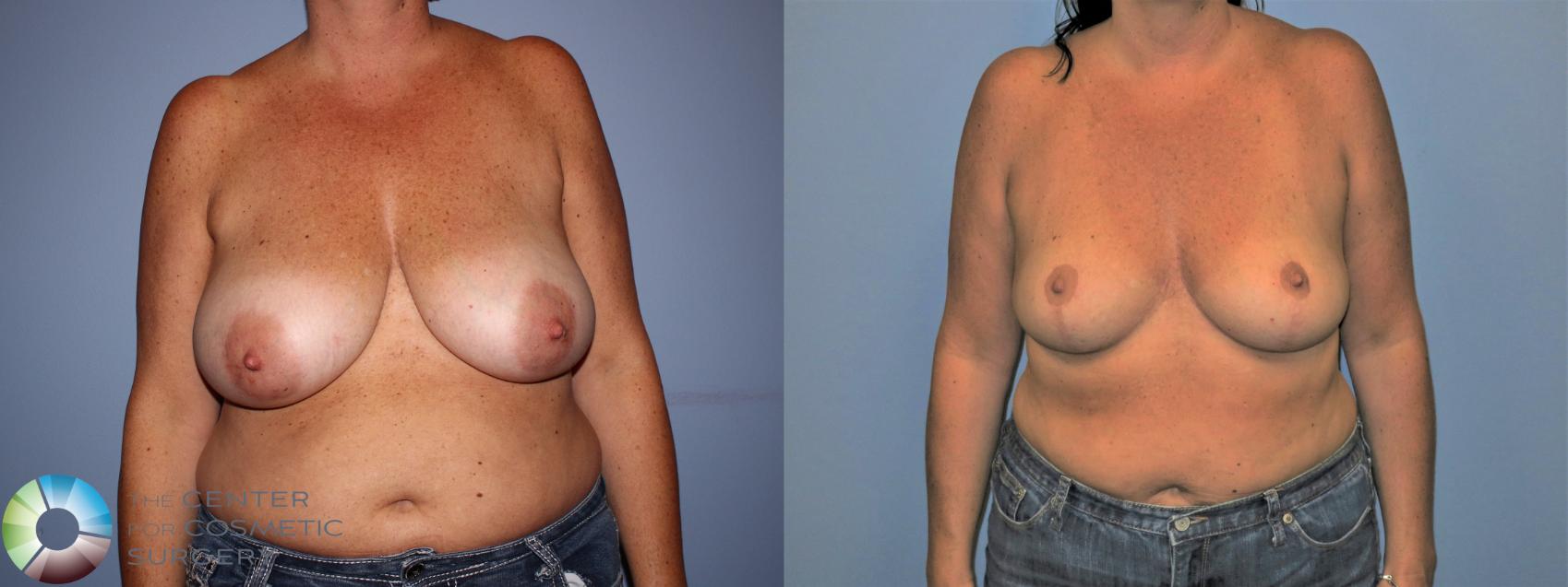 Before & After Breast Reduction Case 11234 Front View in Golden, CO