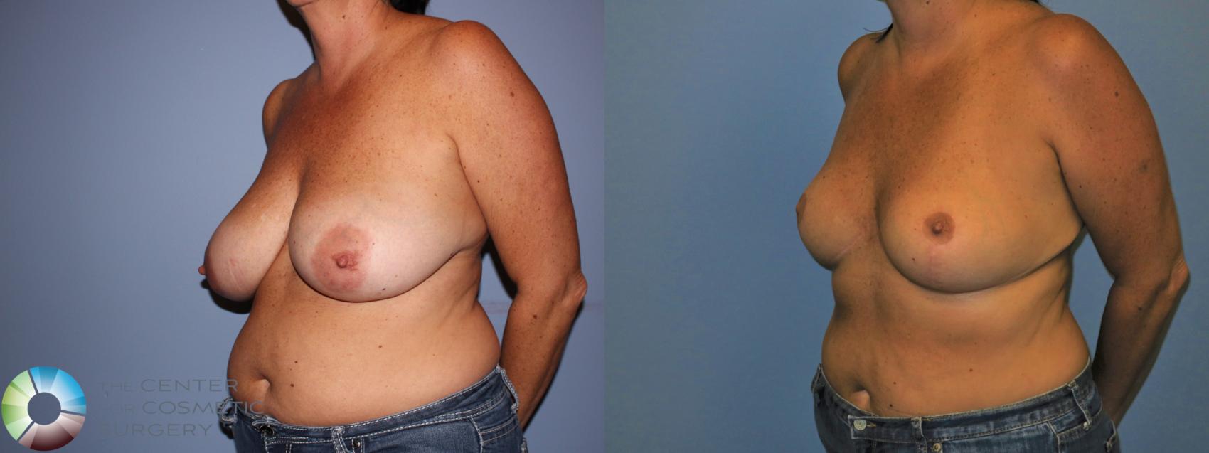 Before & After Breast Reduction Case 11234 Left Oblique View in Golden, CO