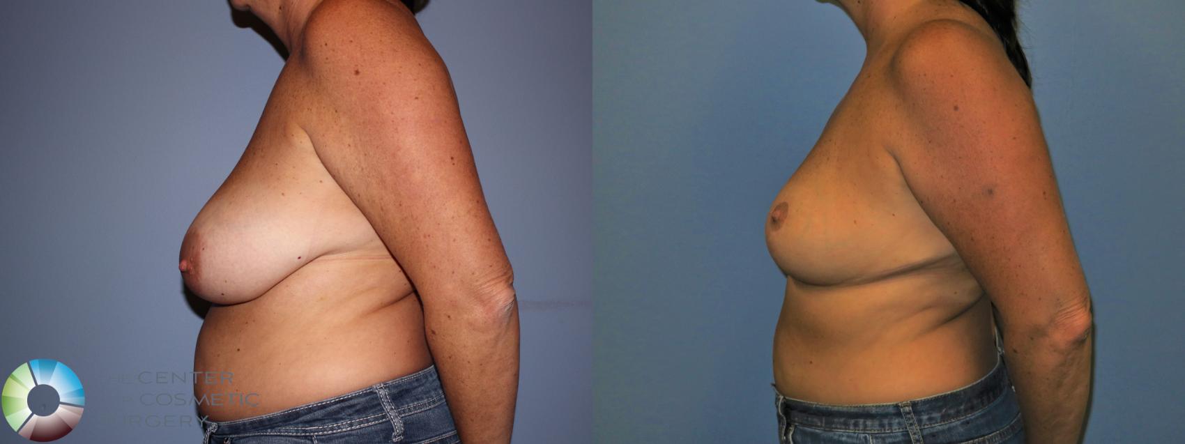 Before & After Breast Reduction Case 11234 Left Side View in Golden, CO