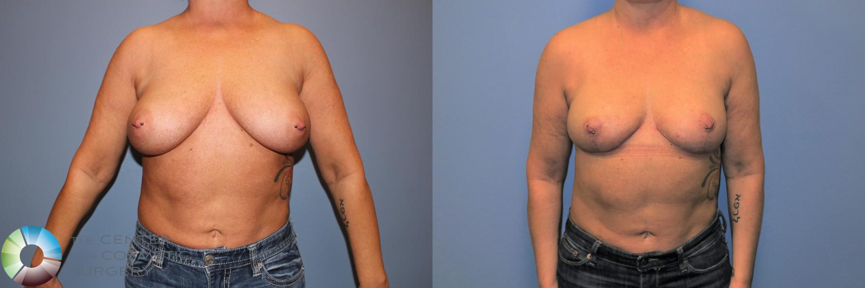 Before & After Breast Lift without Implants Case 11235 Front in Denver and Colorado Springs, CO