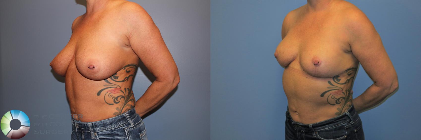 Before & After Breast Reduction Case 11235 Left Oblique View in Denver & Golden, CO