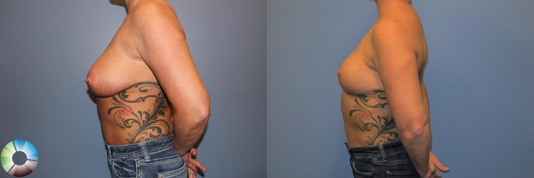 Before & After Breast Reduction Case 11235 Left Side in Denver and Colorado Springs, CO