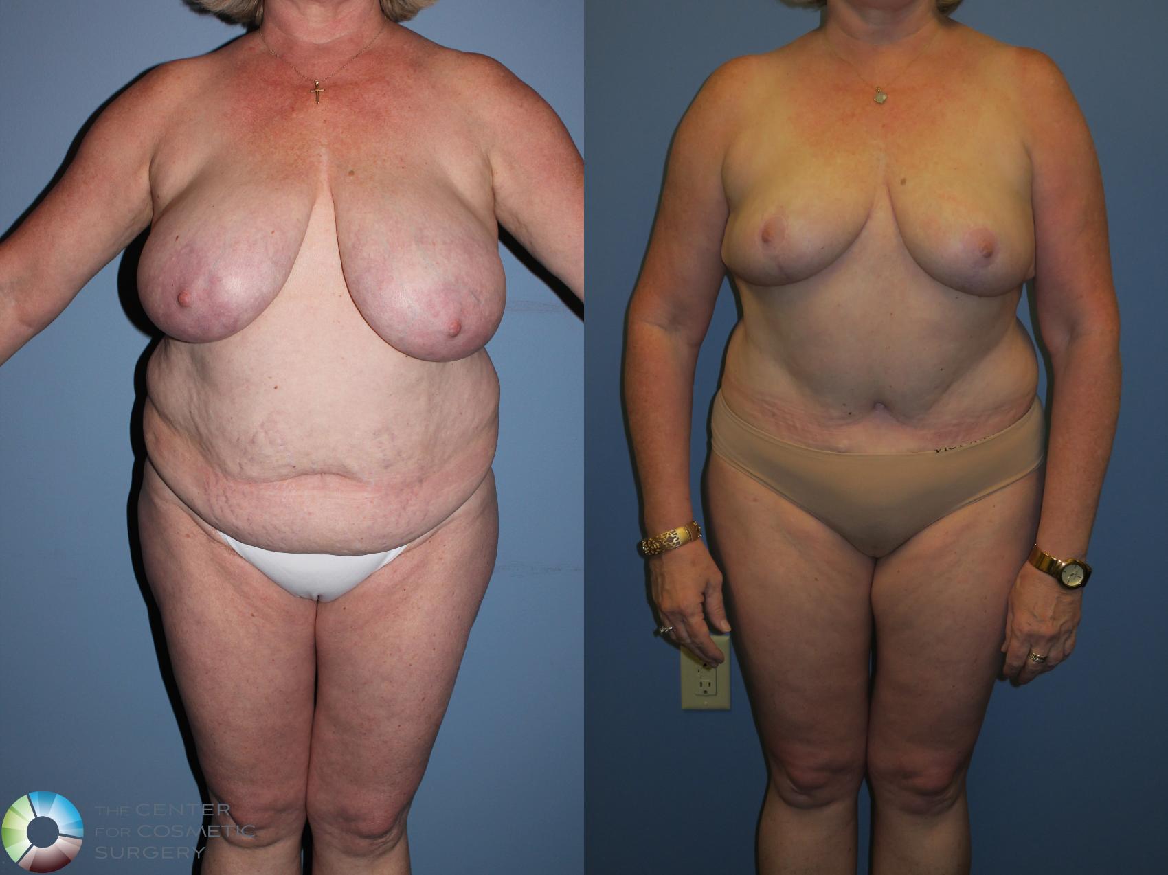 Before & After Breast Reduction Case 11236 Front View in Golden, CO