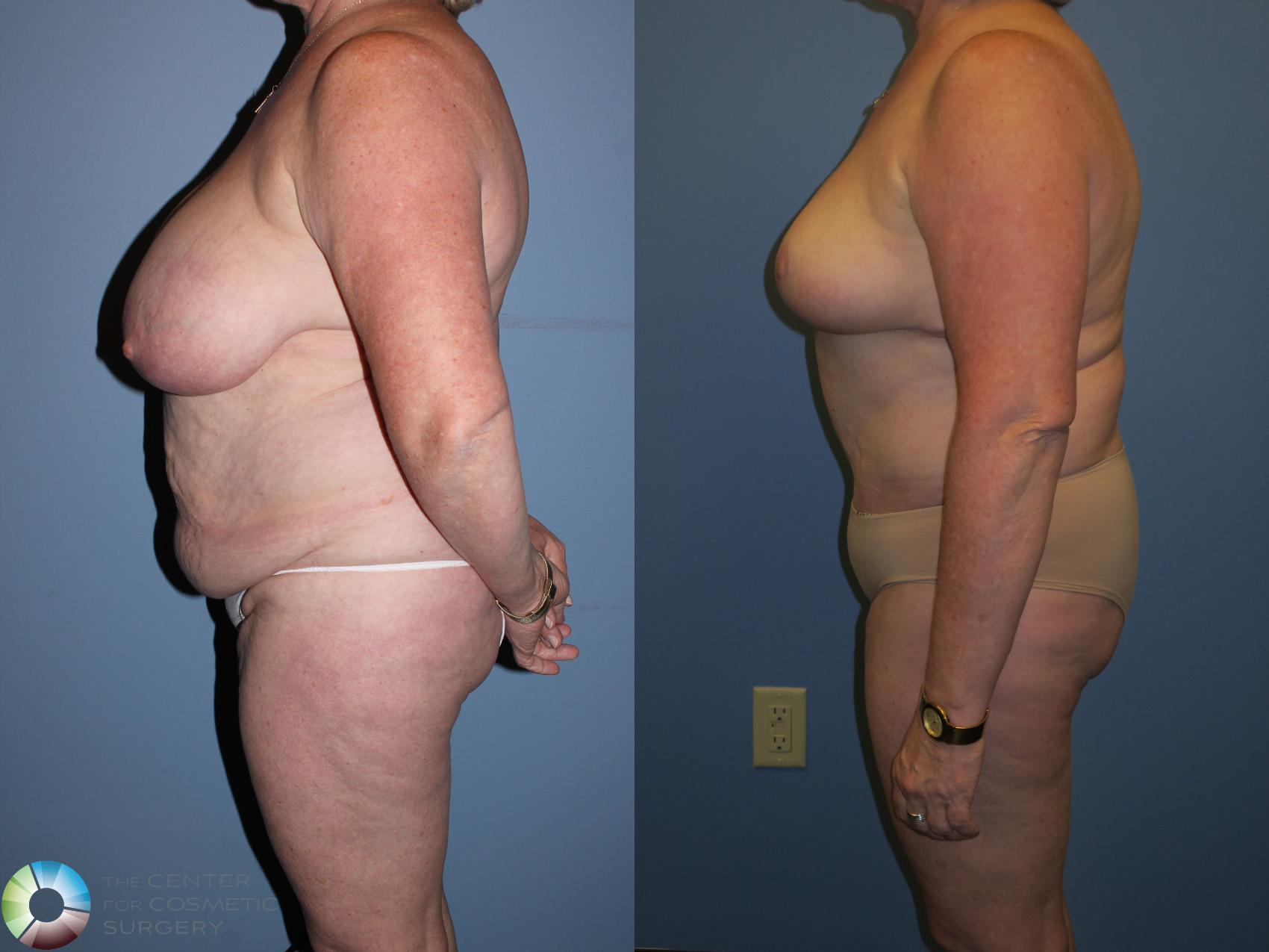 Before & After Breast Reduction Case 11236 Left Side View in Golden, CO