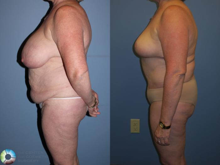 Before & After Breast Reduction Case 11236 Left Side in Denver and Colorado Springs, CO