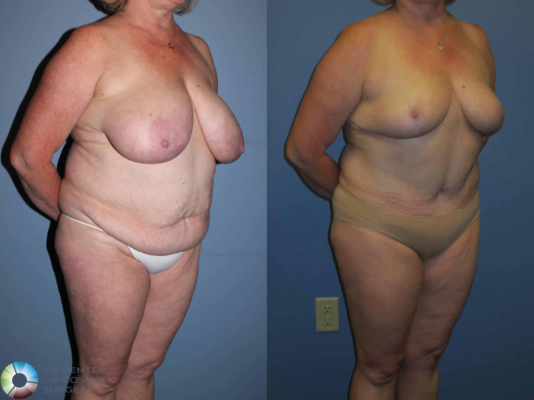 Before & After Breast Reduction Case 11236 Right Oblique View in Golden, CO