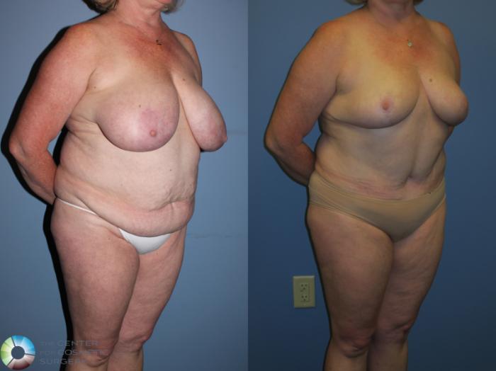 Before & After Breast Reduction Case 11236 Right Oblique in Denver and Colorado Springs, CO