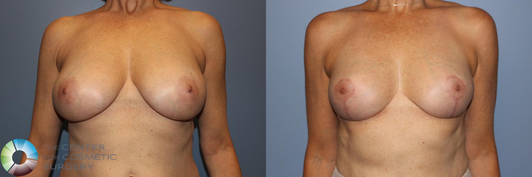 Before & After Breast Reduction Case 11244 Front View in Golden, CO