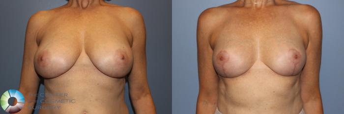 Before & After Breast Reduction Case 11244 Front in Denver and Colorado Springs, CO