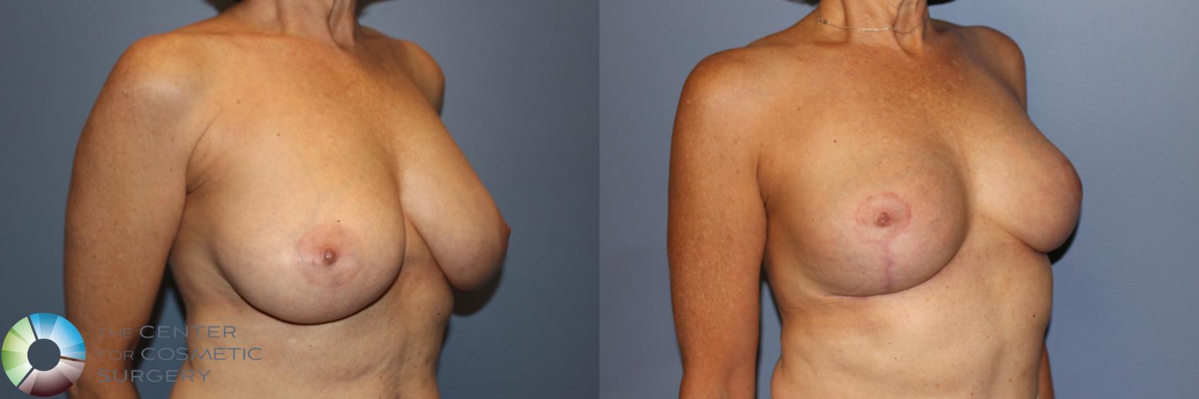 Before & After Breast Reduction Case 11244 Right Oblique View in Golden, CO