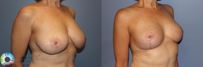 Before & After Breast Reduction Case 11244 Right Oblique in Denver and Colorado Springs, CO