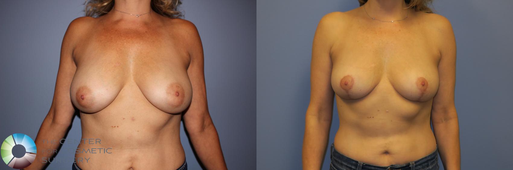 Before & After Breast Reduction Case 11261 Front View in Golden, CO