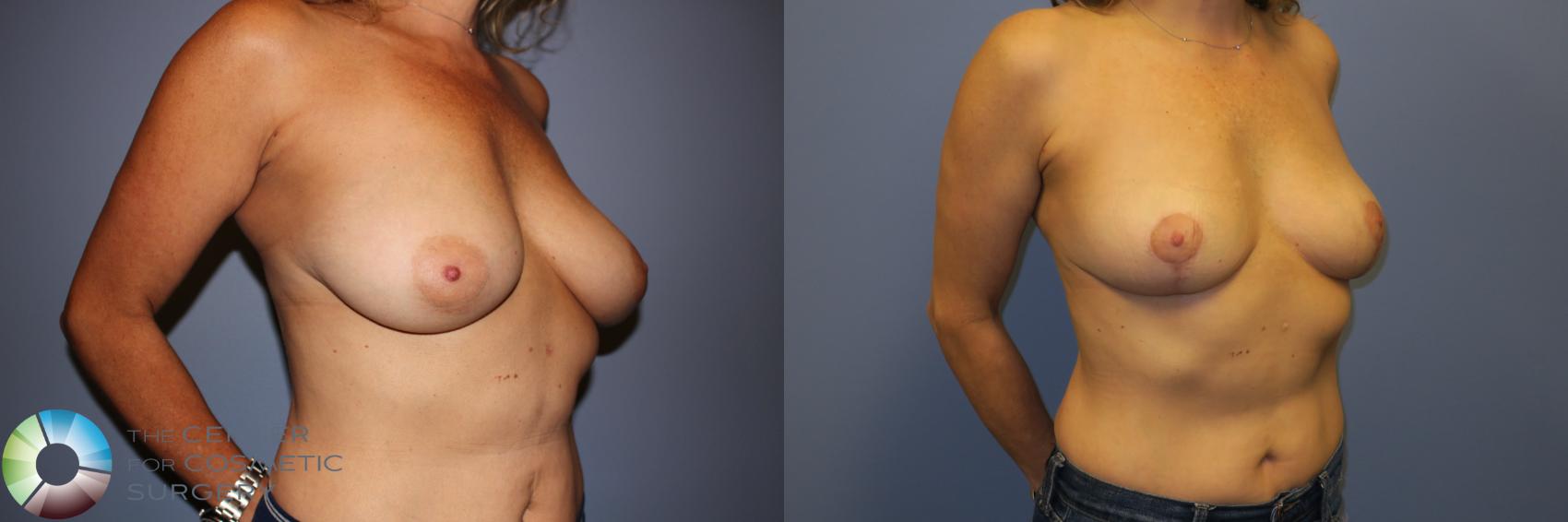 Before & After Breast Reduction Case 11261 Right Oblique View in Golden, CO
