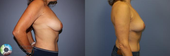 Before & After Breast Reduction Case 11261 Right Side View in Golden, CO