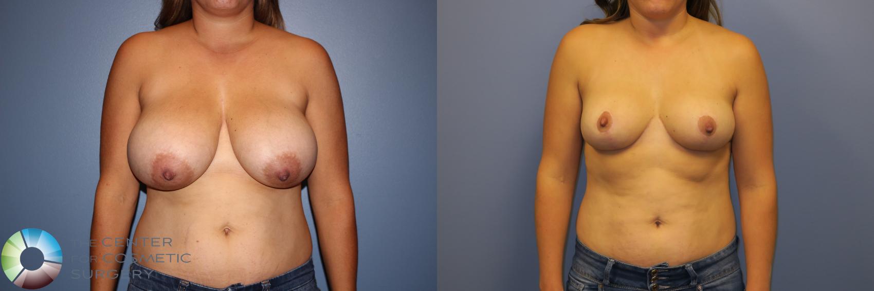 Before & After Breast Reduction Case 11262 Front in Denver and Colorado Springs, CO