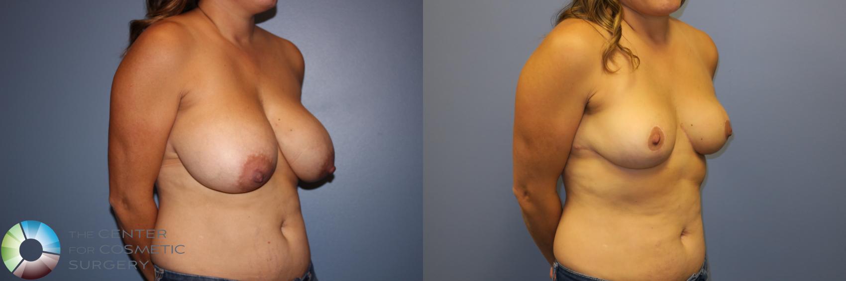 Before & After Breast Reduction Case 11262 Right Oblique View in Denver & Golden, CO