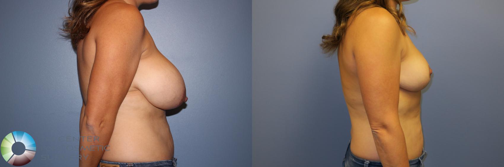 Before & After Breast Reduction Case 11262 Right Side View in Denver & Golden, CO