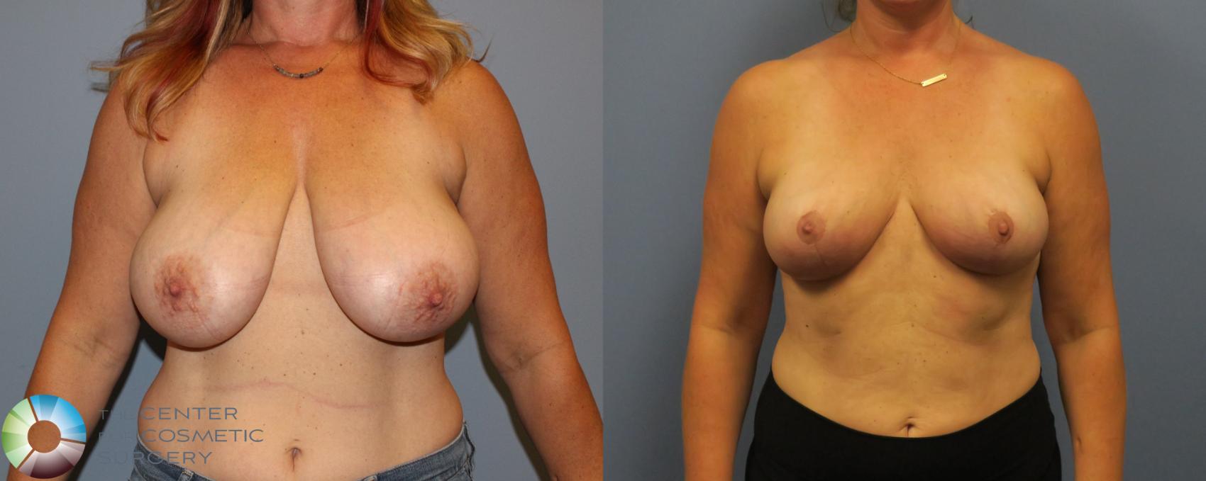 Before & After Breast Reduction Case 11285 Front View in Golden, CO