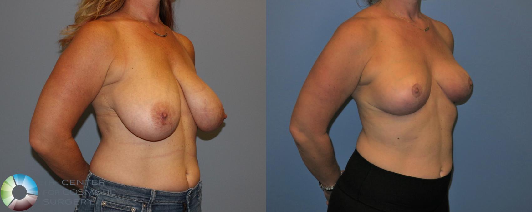 Before & After Breast Reduction Case 11285 Right Oblique View in Denver & Golden, CO