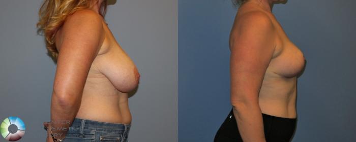Before & After Breast Reduction Case 11285 Right Side View in Golden, CO