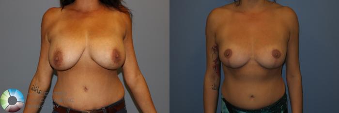 Before & After Breast Reduction Case 11286 Front in Denver and Colorado Springs, CO
