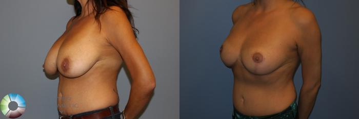 Before & After Breast Reduction Case 11286 Left Oblique in Denver and Colorado Springs, CO