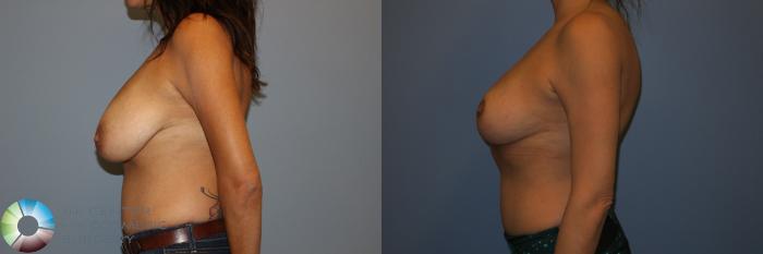 Before & After Breast Reduction Case 11286 Left Side in Denver and Colorado Springs, CO
