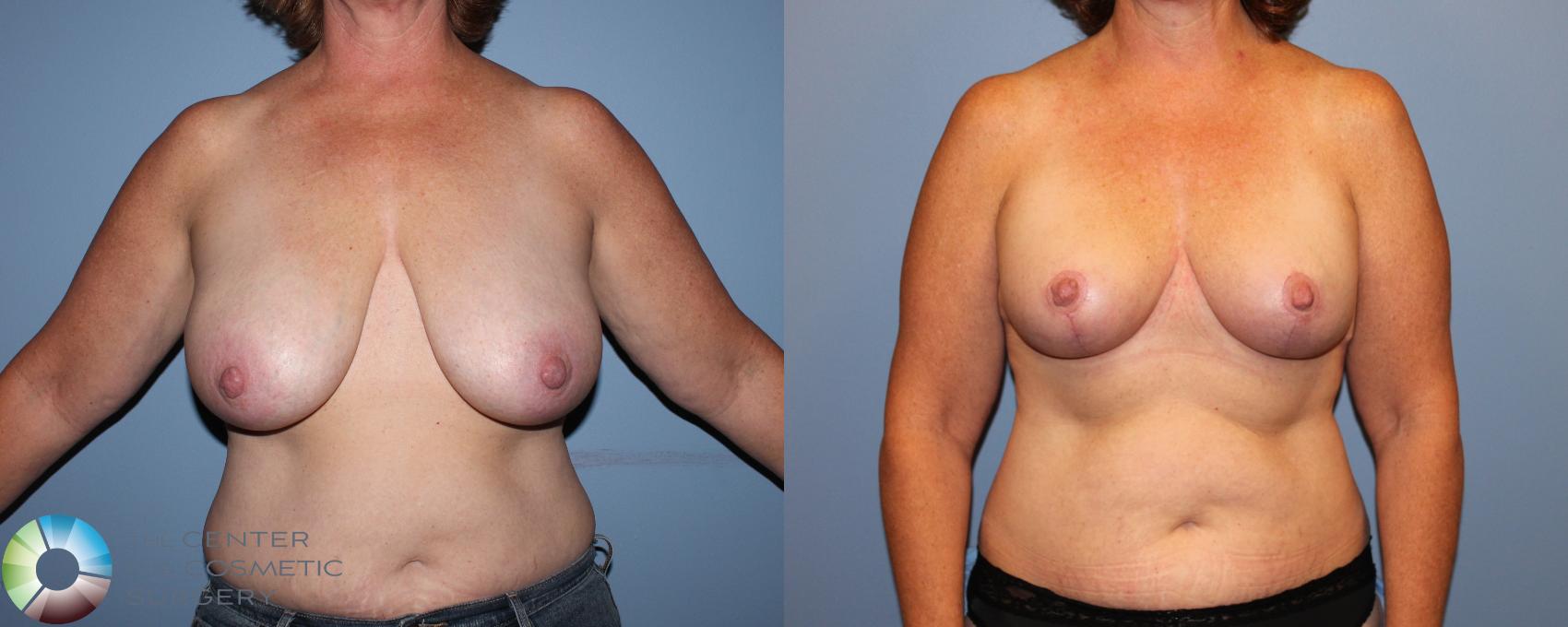 Before & After Breast Reduction Case 11287 Front in Denver and Colorado Springs, CO