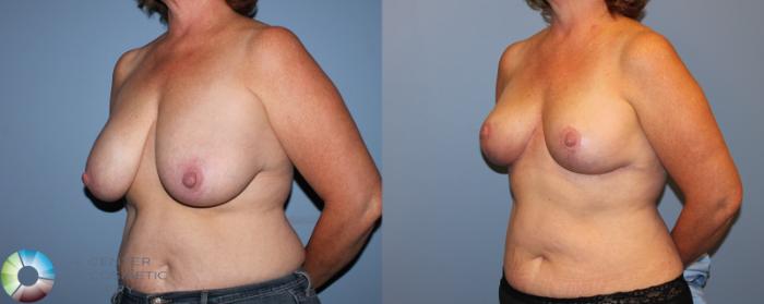 Before & After Breast Reduction Case 11287 Left Oblique View in Golden, CO