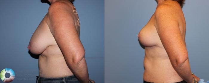 Before & After Breast Reduction Case 11287 Left Side View in Golden, CO