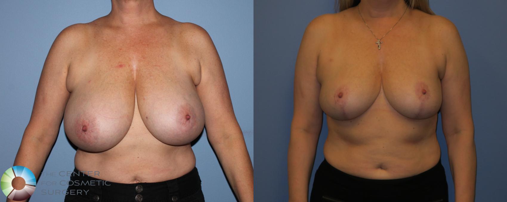 Before & After Breast Reduction Case 11288 Front View in Denver & Golden, CO