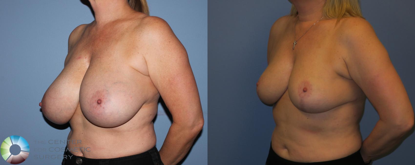 Before & After Breast Reduction Case 11288 Left Oblique View in Denver & Golden, CO
